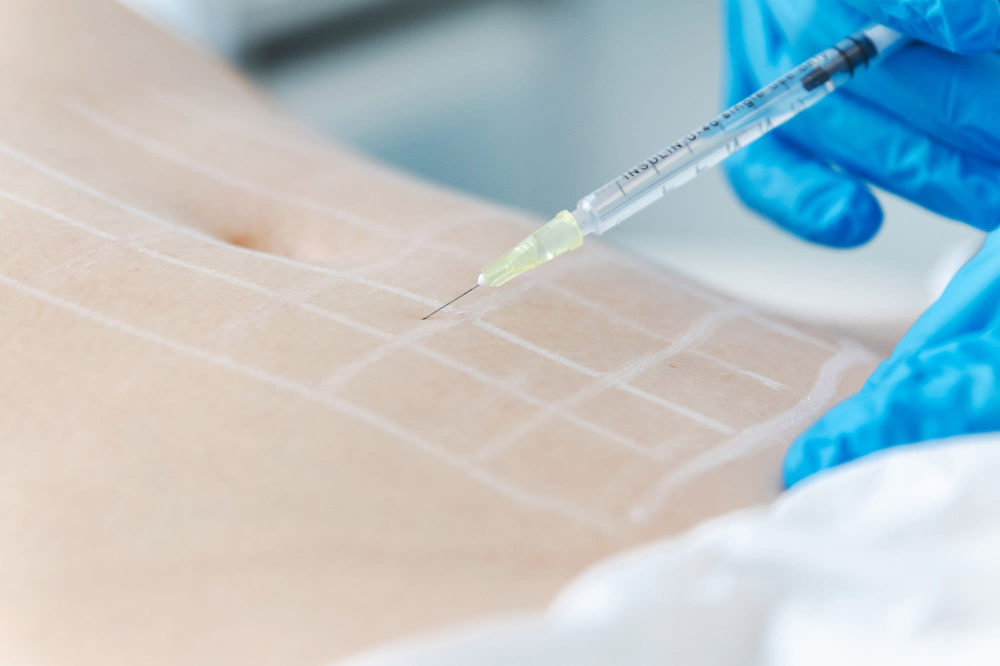 Behandlung einer Patientin mit einer Fettwegspritze in München bei VIVIDA Lab.